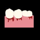 , a common symptom of pregnancy-related gingivitis"