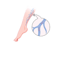 Varicose veins